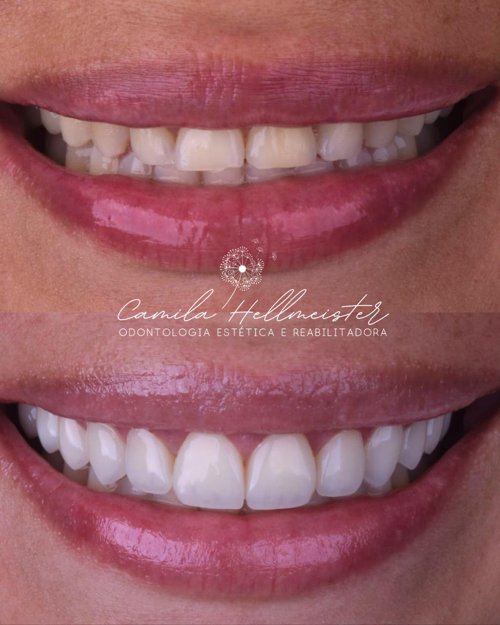 Gengivoplastia + Resina Composta