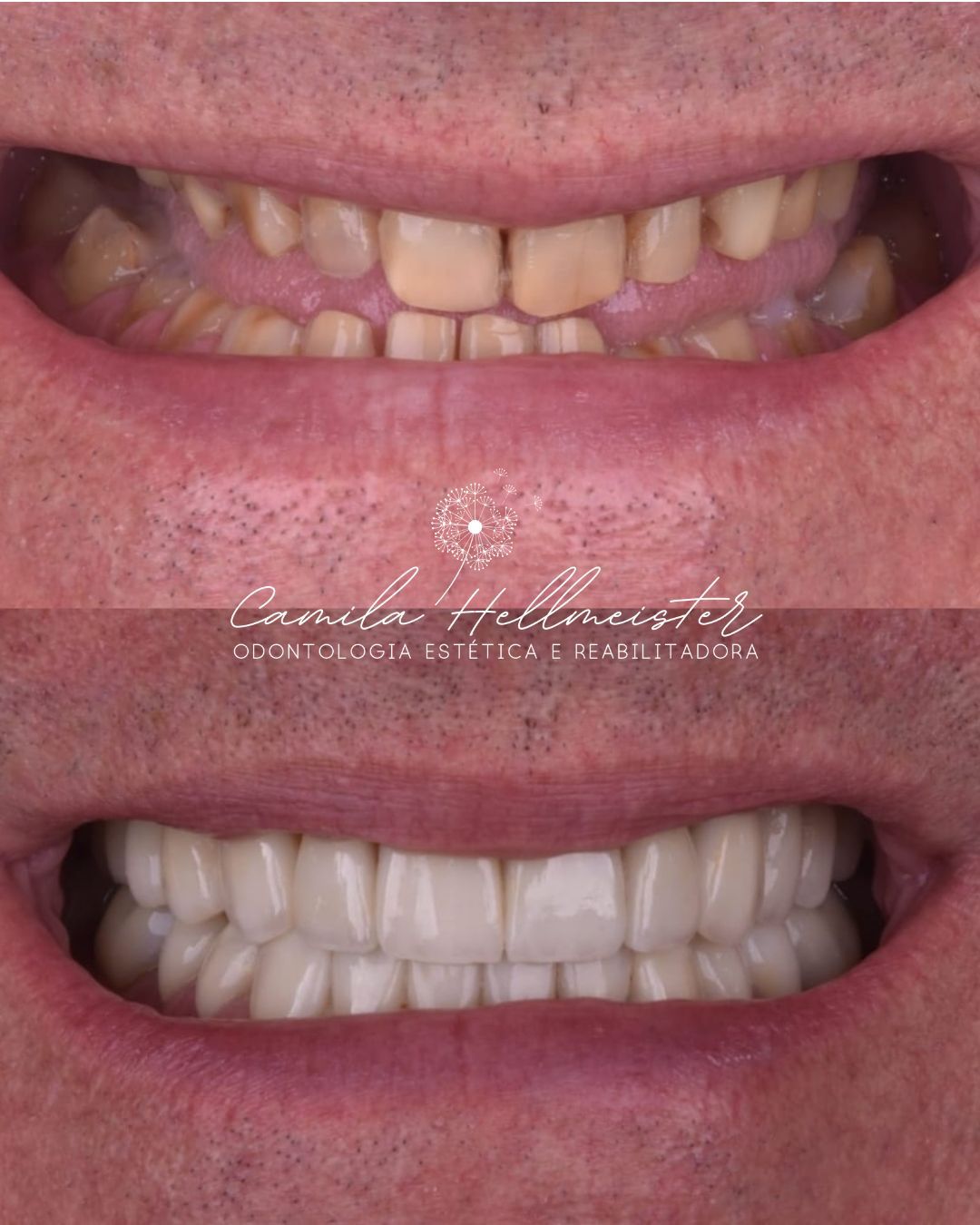 Antes e depois de facetas de porcelana - Caso 2 - Dra. Camila Hellmeister