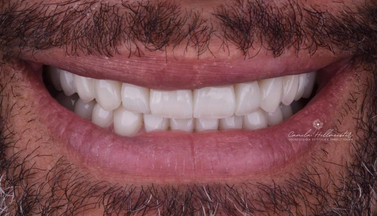 Facetas de Porcelana - Resultado