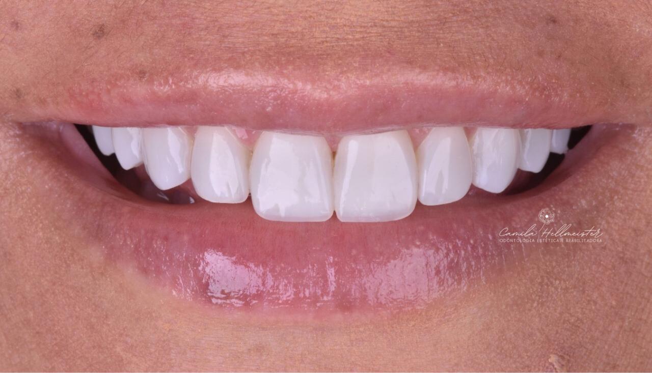 Facetas de Resina - Resultado